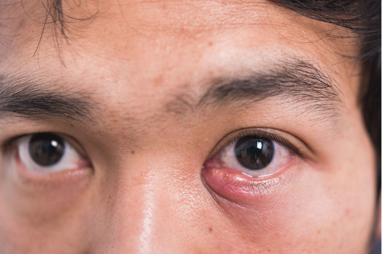 How to Treat and Prevent Styes