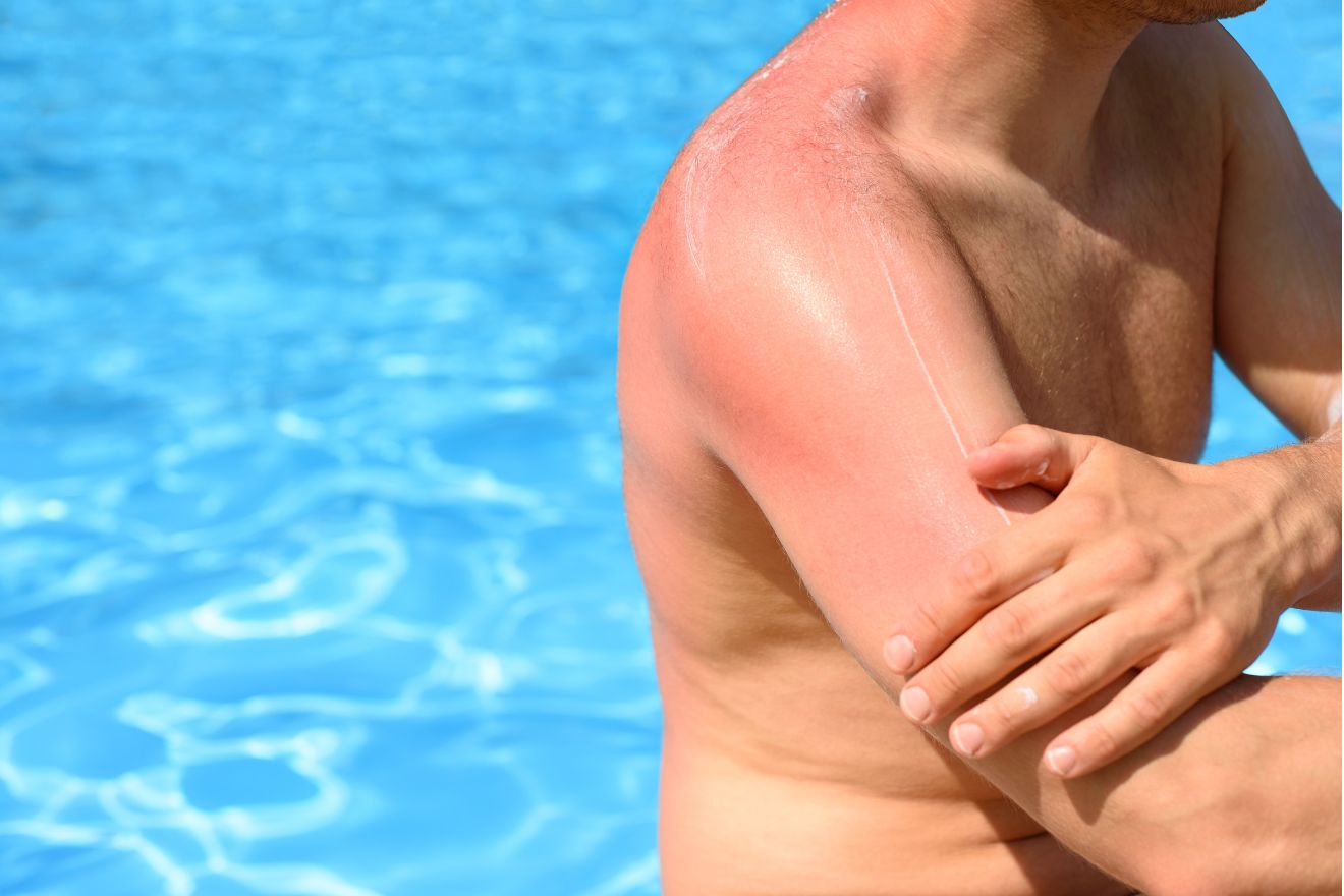 How to Recover Fast from a Sunburn
